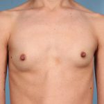 Breast Augmentation Before & After Patient #6296