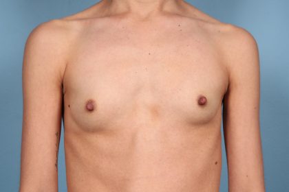Breast Augmentation Before & After Patient #6296