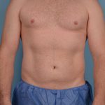 Hi-Def Liposuction Before & After Patient #5455
