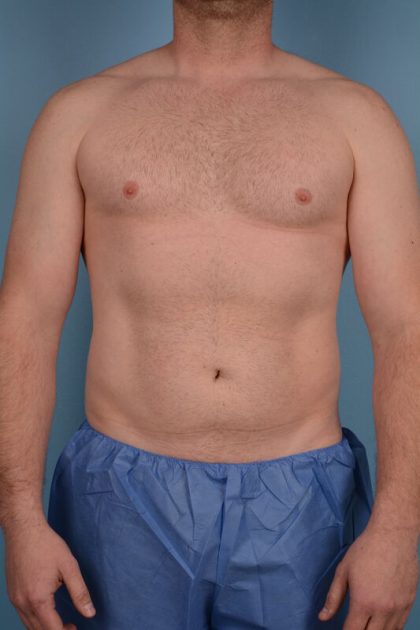 Hi-Def Liposuction Before & After Patient #5455