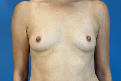 Breast Augmentation Before & After Patient #6299