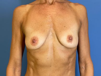 Breast Augmentation Before & After Patient #6335