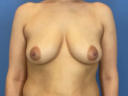 Breast Augmentation Before & After Patient #6337