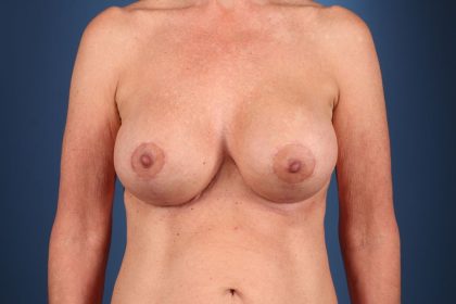 Breast Lift with Augmentation Before & After Patient #6509