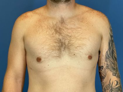Gynecomastia Before & After Patient #6645