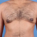 Gynecomastia Before & After Patient #6652
