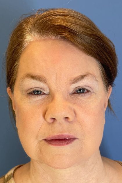 Eyelid Surgery Before & After Patient #6741