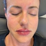 Lip Fillers Before & After Patient #7193