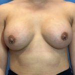 Breast Augmentation Before & After Patient #6089