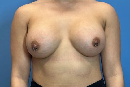 Breast Augmentation Before & After Patient #6089