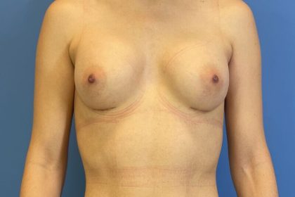 Breast Augmentation Before & After Patient #6174