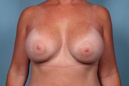 Breast Augmentation Before & After Patient #6181