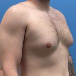 Gynecomastia Before & After Patient #6645