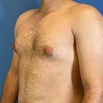 Gynecomastia Before & After Patient #6649