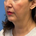 Facelift Before & After Patient #6778