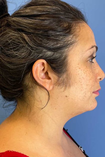 Neck (Submental) Liposuction Before & After Patient #6843