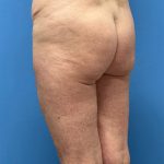 Brazilian Butt Lift Before & After Patient #5377