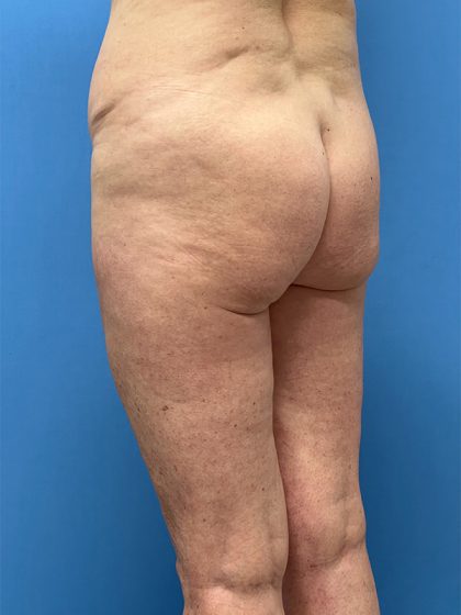 Brazilian Butt Lift (BBL) Before & After Patient #5377
