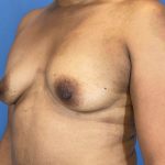 Breast Augmentation Before & After Patient #6297