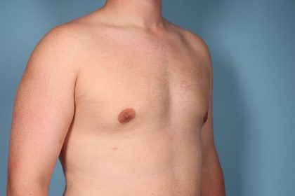 Gynecomastia Before & After Patient #6646