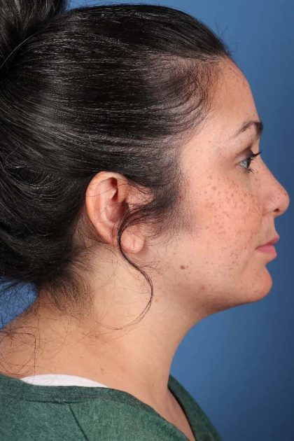 Neck (Submental) Liposuction Before & After Patient #6843