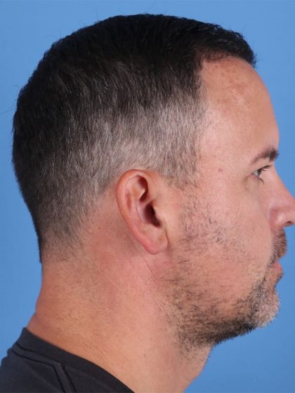 Hair Transplant Before & After Patient #6912
