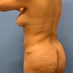 Brazilian Butt Lift Before & After Patient #5378