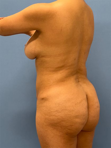 Brazilian Butt Lift Before & After Patient #5378