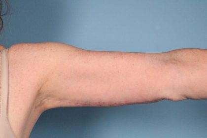 Arm Lift Before & After Patient #5258