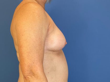 Breast Augmentation Before & After Patient #6389