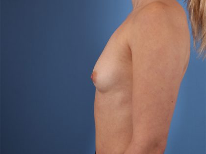 Breast Augmentation Before & After Patient #6416