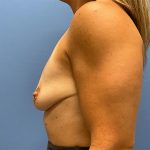 Breast Augmentation Before & After Patient #6422