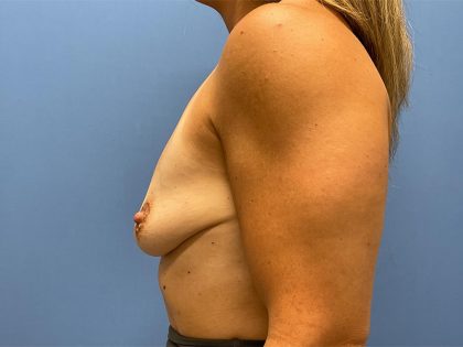 Breast Augmentation Before & After Patient #6422