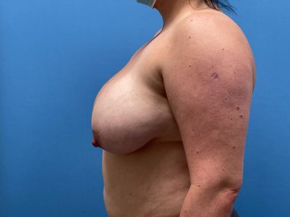 Breast Lift Before & After Patient #6510