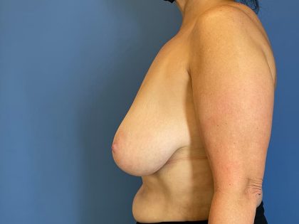 Breast Lift Before & After Patient #6514