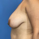 Breast Lift Before & After Patient #6513
