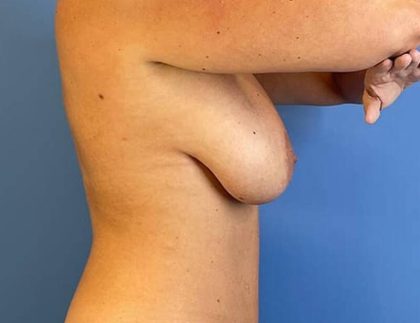 Breast Lift with Augmentation Before & After Patient #6515