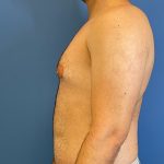 Gynecomastia Before & After Patient #6649