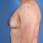 Gynecomastia Before & After Patient #6652
