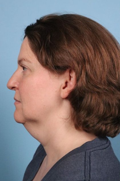 Face & Neck Lift Before & After Patient #6808