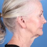 Face & Neck Lift Before & After Patient #6811
