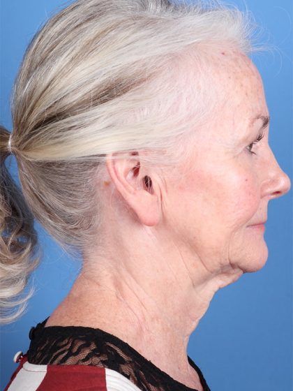Face & Neck Lift Before & After Patient #6811