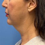 Face & Neck Lift Before & After Patient #6812
