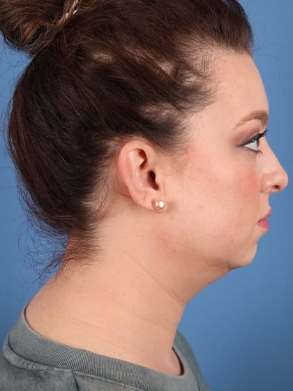 Neck (Submental) Liposuction Before & After Patient #6844