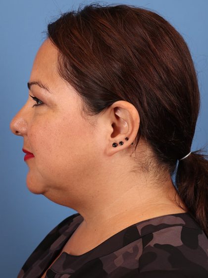 Neck (Submental) Liposuction Before & After Patient #6846