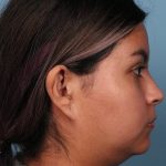 Neck (Submental) Liposuction Before & After Patient #6845