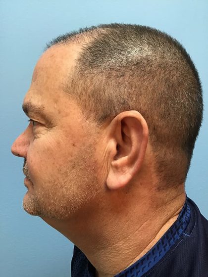 Hair Transplant Before & After Patient #6909