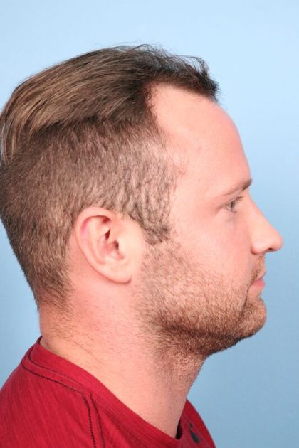 Hair Transplant Before & After Patient #6910
