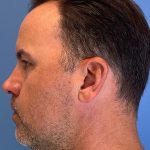 Hair Transplant Before & After Patient #6912