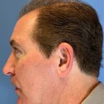 Hair Transplant Before & After Patient #6913